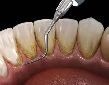 τακτικός καθαρισμός των δοντιών